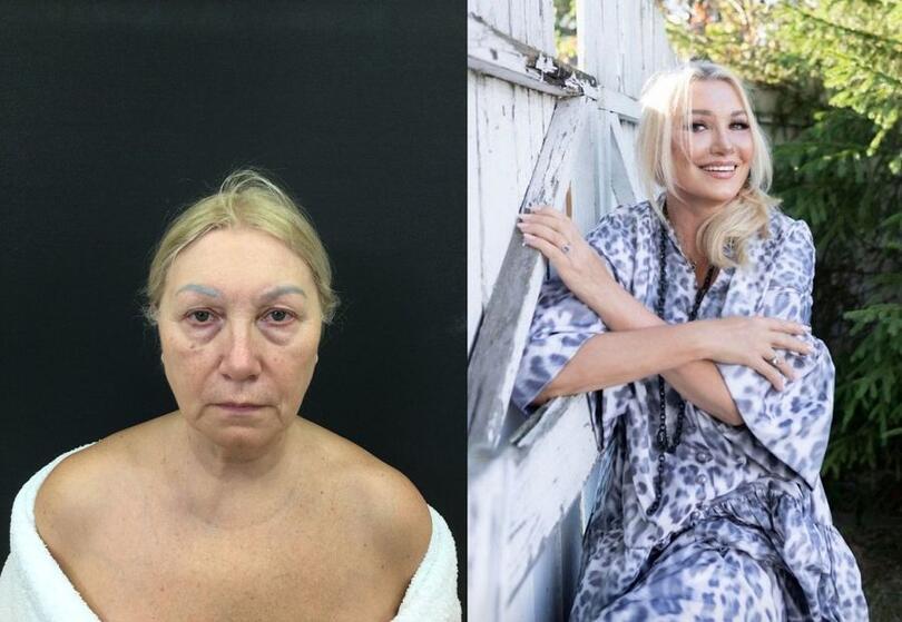 62-летняя россиянка сделала пластику после гибели мужа и помолодела вдвое